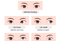 BỆNH LÉ (LÁC) MẮT: NGUYÊN NHÂN, TRIỆU CHỨNG VÀ CÁCH ĐIỀU TRỊ