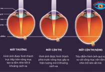 BIẾN CHỨNG CẬN THỊ CỰC NGUY HIỂM CÓ THỂ PHÒNG TRÁNH ĐƯỢC KHI KIỂM SOÁT CẬN THỊ BẰNG ORTHO-K 