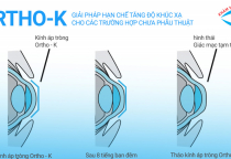 CHỈ ĐỊNH VÀ CHỐNG CHỈ ĐỊNH KHI SỬ DỤNG KÍNH ORTHO-K