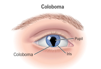 COLOBOMA NGUYÊN NHÂN BIỂU HIỆN VÀ CÁCH ĐIỀU TRỊ 