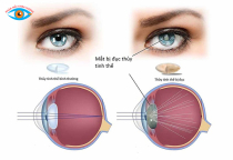 Đục thủy tinh thể (cườm khô) là gì? Nguyên nhân và cách điều trị. 