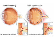 GLAUCOMA VÀ CÁC DẤU HIỆU CÓ THỂ NHẬN BIẾT ? 