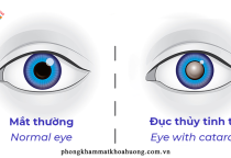 MỔ ĐỤC THỦY TINH THỂ XONG – CÓ PHẢI NHỎ THUỐC SUỐT ĐỜI?