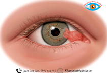 BỆNH MỘNG MẮT (MỘNG THỊT) LÀ GÌ? 