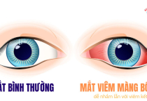 VIÊM MÀNG BỒ ĐÀO BỆNH LÝ NGHIÊM TRỌNG Ở MẮT 