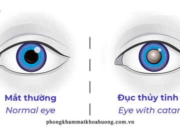 MỔ ĐỤC THỦY TINH THỂ XONG – CÓ PHẢI NHỎ THUỐC SUỐT ĐỜI?